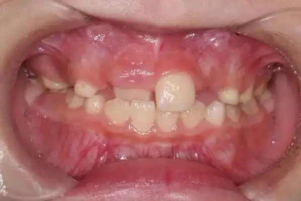 龅牙要等换完牙再矫正? 我差点耽误了孩子