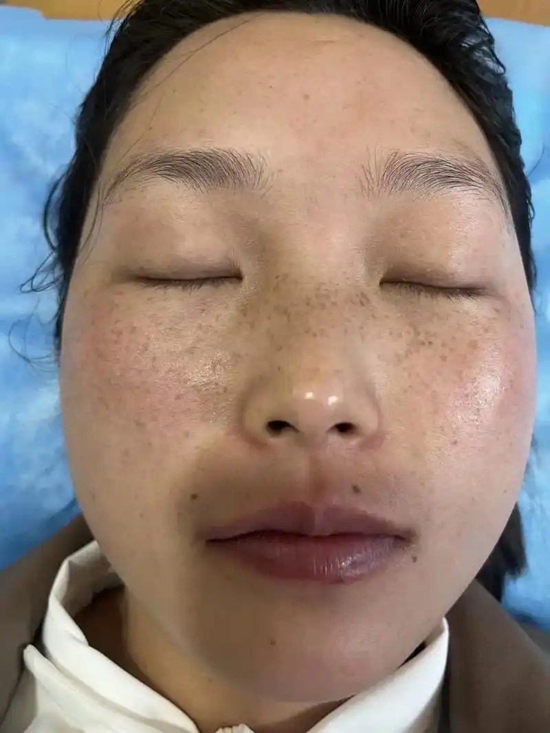 93雀斑也叫苍蝇屎95爆发最早的年龄段是5一12岁,中阶段是16一18岁