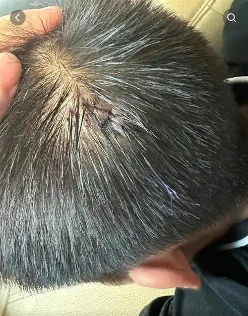 男孩被跆拳道教练踢到后头部撞墙受伤,校方:非故意伤害,孩子身体已无