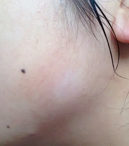 请问这脸部白斑是怎么回事?