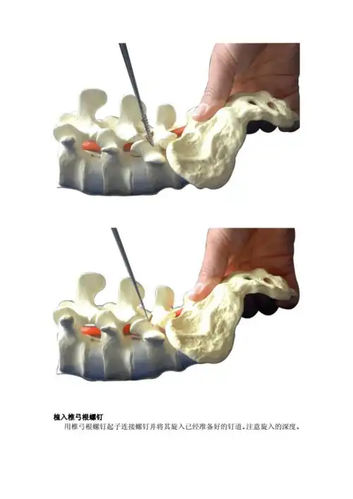 sinoupass胸腰椎后路钉棒系统pdf16页