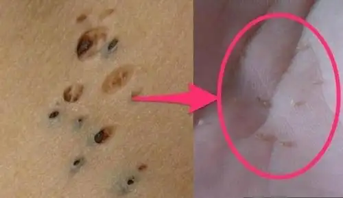 难道是毛孔里的螨虫!