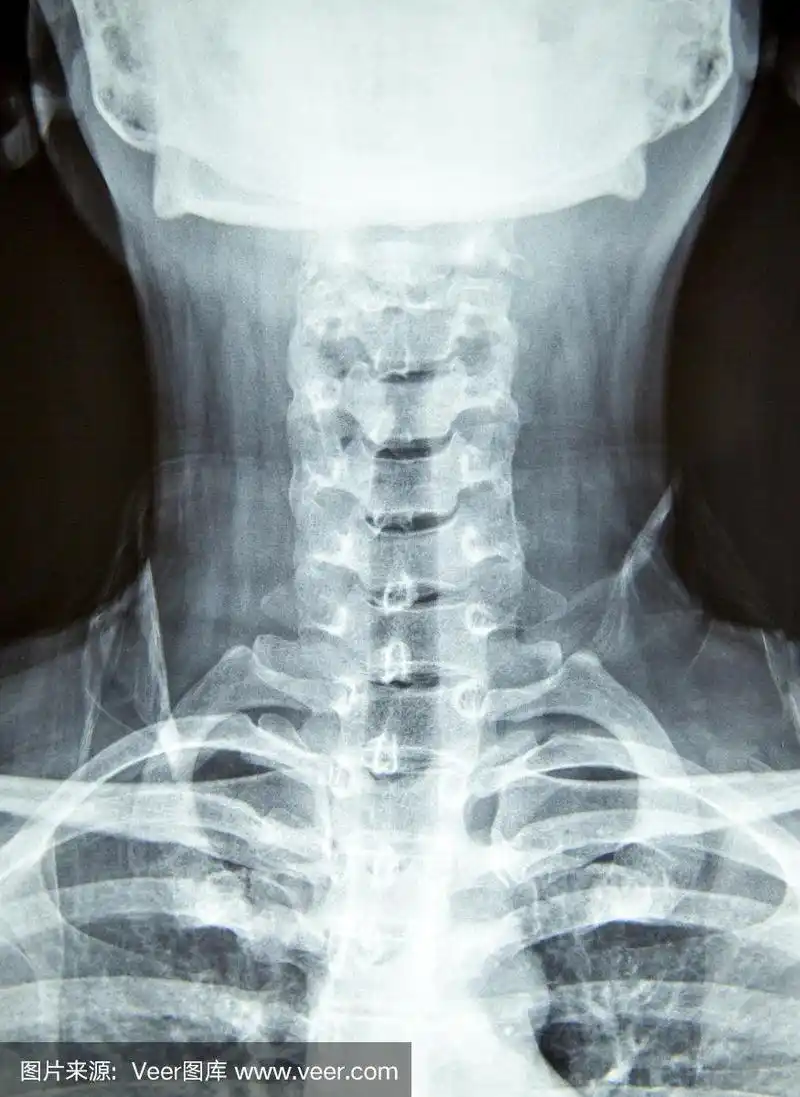 近距离x线片显示颈椎或颈椎,颈骨x线片.放射学教育人体解剖学.