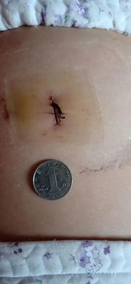 腰椎间盘突出症不要怕,微创来解决