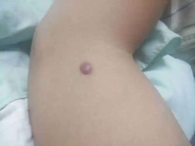 胳膊上张个疙瘩