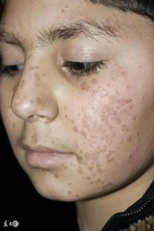 扁平疣的形状有哪些(扁平疣最大的特点是什么)(1)