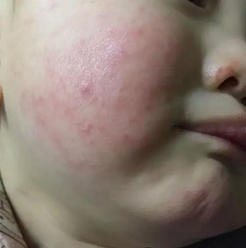 宝宝两岁了,最近脸上出了一些这样的红疙瘩,之前多次出湿疹,这样的