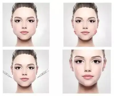 肉毒素瘦脸前后对比图