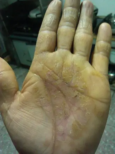 我妈妈的手从去年7月到现在了,手掌干裂,不愈合.切反复.去了好多医院.