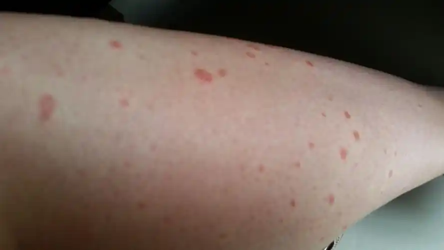 虫咬性皮炎为螨虫,蚊,臭虫,跳蚤,蜂等昆虫将口器刺入皮肤吸血,或者将