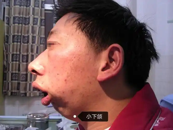 比如常见的儿童扁桃体肥大(图二),腺样体肥大,成人的肥胖(图三),咽腔