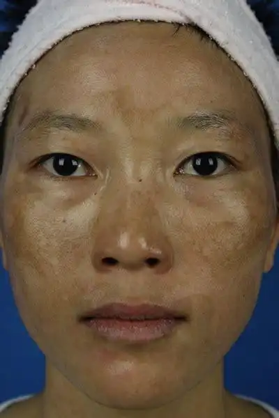 产后为什么妊娠斑退不掉