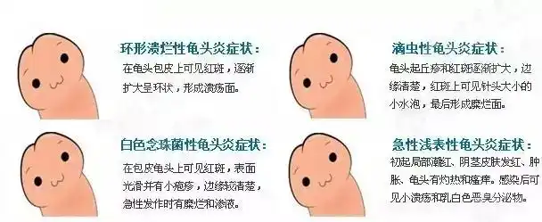 一般而言,包皮龟头炎可分为以下几个类型