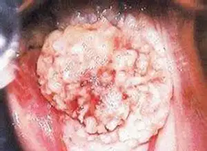 溃疡外观呈菜花样