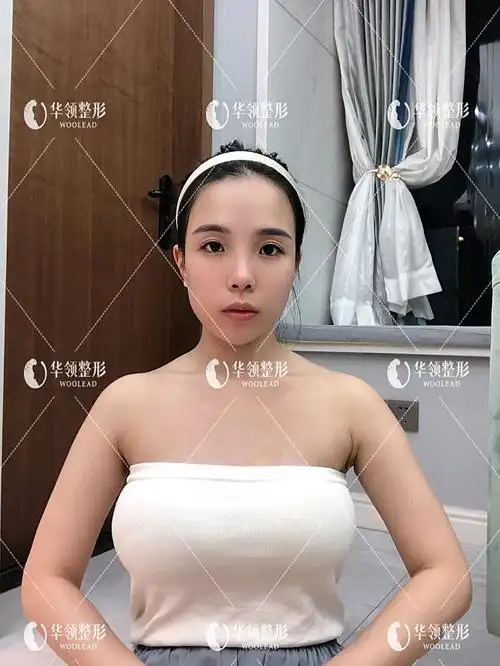 胸部手术术后3天今天是做完丰胸的第三天了,看着自己_圈子-新氧美容