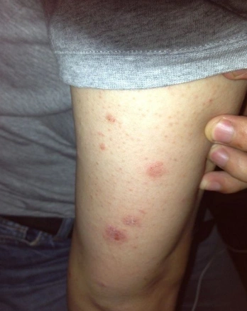 梅毒二期症状 (32)