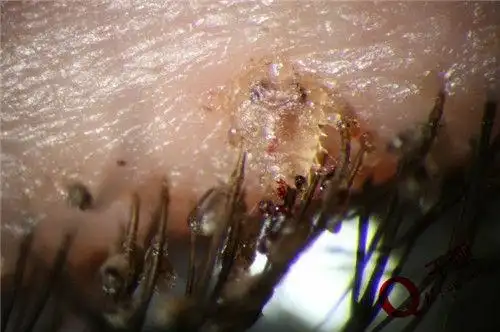 这些虱子不会传播艾滋病毒,但由于这是一个阴虱,所以医生建议还是要做