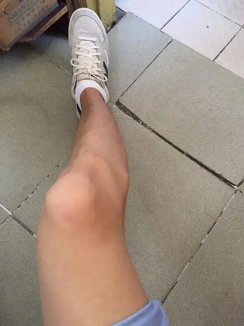 感觉小腿有点o型,膝盖外侧有块小骨头很突出,大概高中就这么突出吧