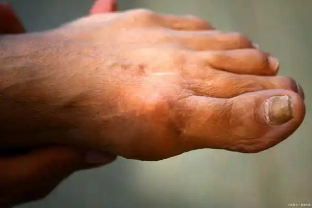 血管闭塞性脉管炎早期的典型症状