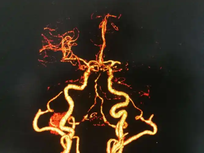 cta 左侧大脑中动脉闭塞