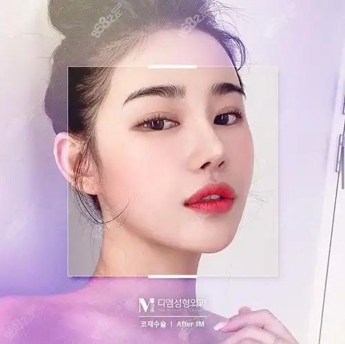 韩国迪美整形医院,做鼻子,非常注重细节,觉得每一处都不可小视,整鼻子