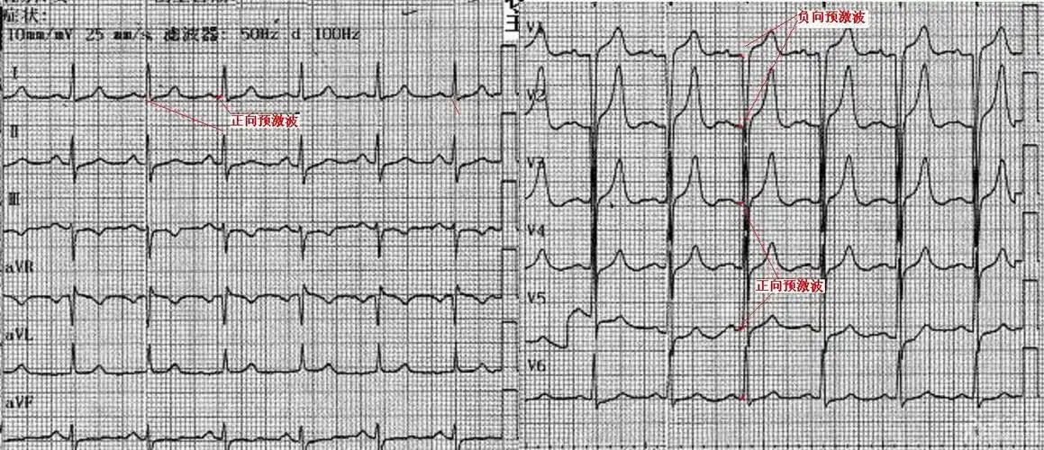 李群娟-异常q波心电图-2-2.jpg