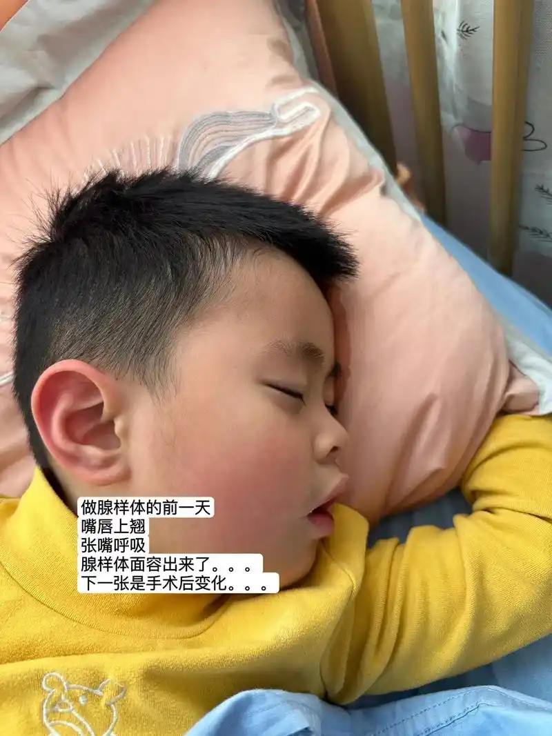 孩子的变化太大了.翻相册看到姐姐和弟弟腺样体做完以后的变 - 抖音