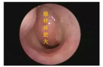 「中民耳鼻喉科普」腺样体肥大怎么办?