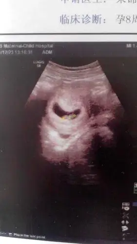 孕囊长的 b超女孩