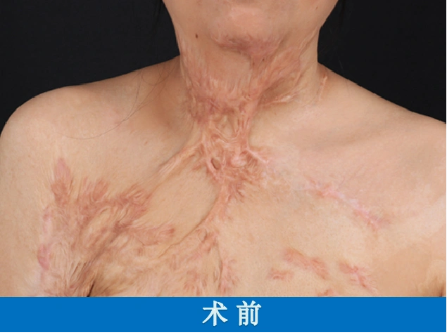 四川西昌突发山火致20余人死伤,烧伤疤痕该如何修复?