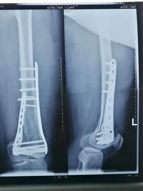 股骨髁间粉碎性骨折(c2型)