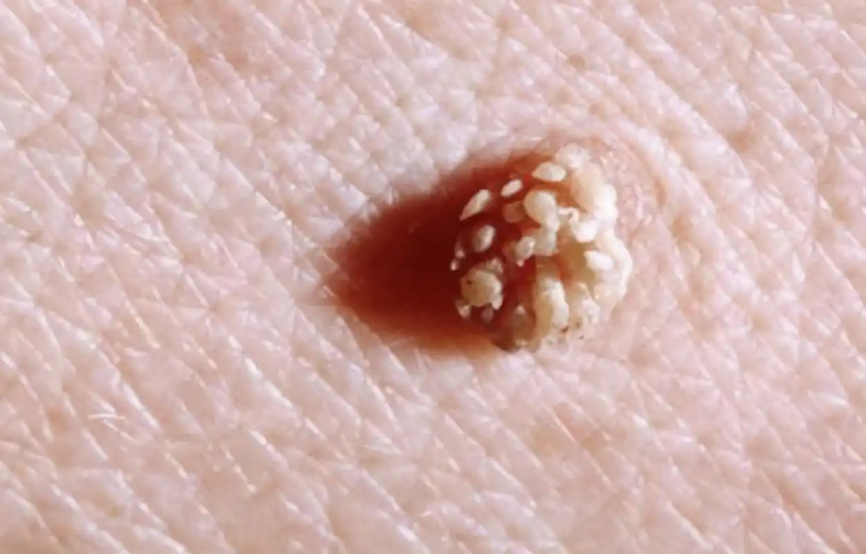 夏天女性手臂上长的淡红色小点,真的只是过敏?或与hpv有关