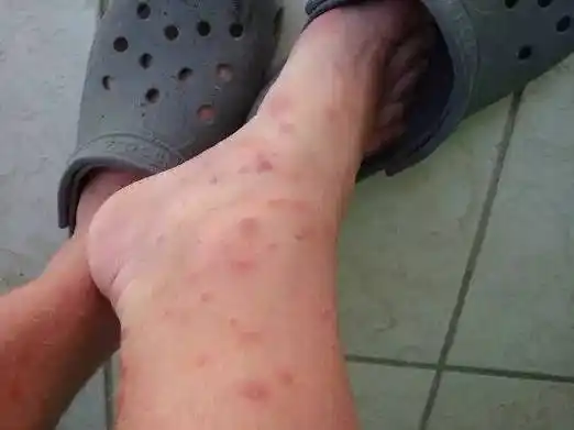 加拿大床虱大爆发!多伦多及士嘉堡虫最多!