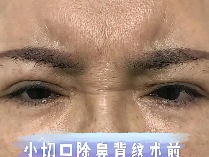 时尚的阿姨对自己面部的要求非常高,鼻背纹困扰了她很_圈子-新氧美容