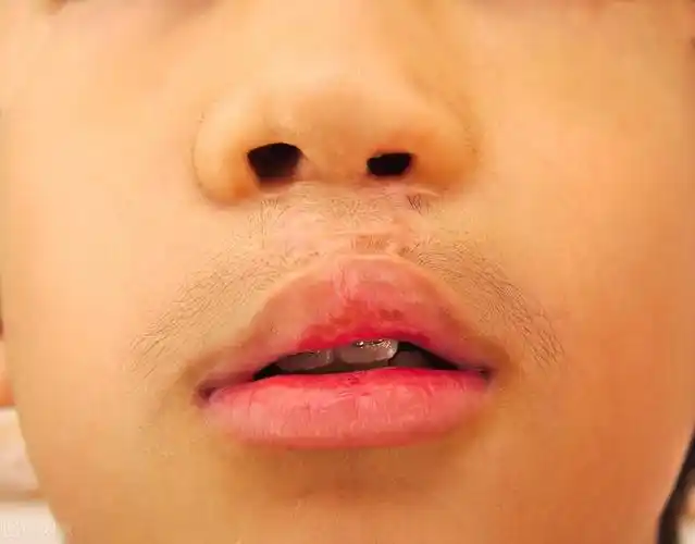 家长关心的腭裂问题有哪些语言训练重点知多少