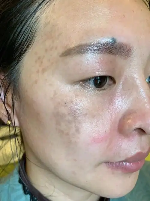 老顾客介绍过来的真皮斑,期待她的脱变吧.