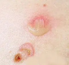 生殖器疱疹_生殖器疱疹症状表现 - 好大夫在线