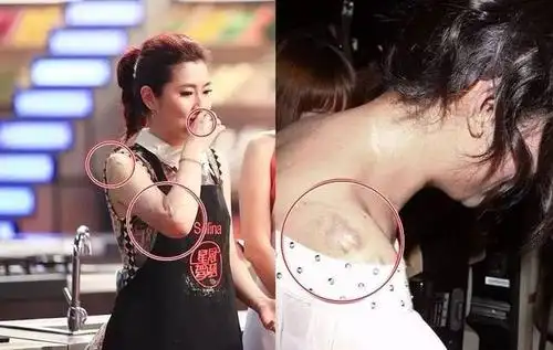 最终右眼留下了明显疤痕 一场大火 给selina留下 一身烧伤 疤痕 事业