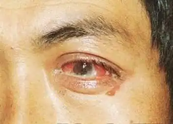 淋病患者的饮食清单