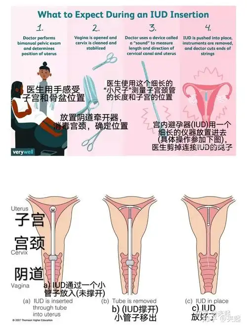 林奇综合症管理(4) - 我上环啦(曼月乐iud)