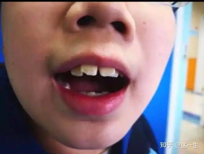 鼻炎腺样体肥大导致睡觉鼻塞张嘴呼吸影响颜值如何破局