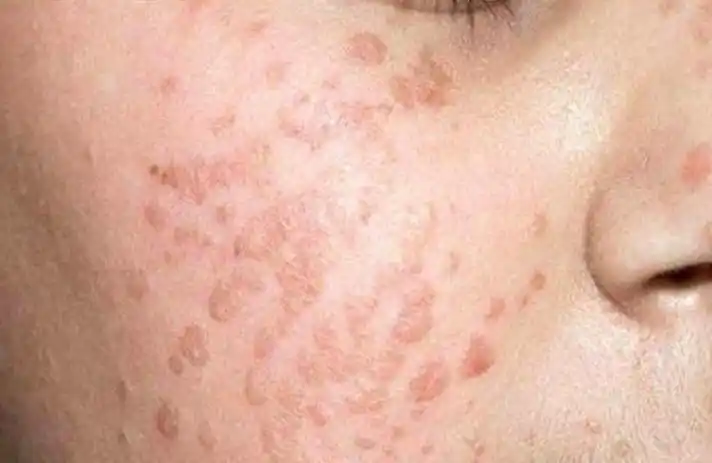 一般情况下不会发生癌变,毕竟引起扁平疣的hpv病毒主要是hpv3,10以及