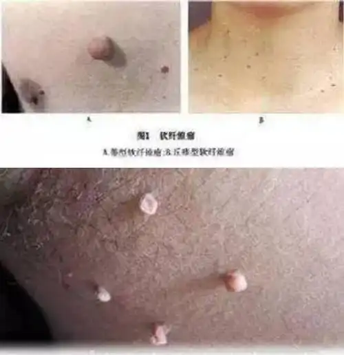 临床以多发性丝状或蒂状赘生物为主要表现,又称皮赘,软瘊.