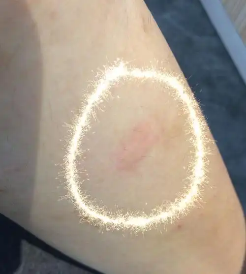 我之前去看了,医生说是螨虫,可是为什么我去同学家睡还