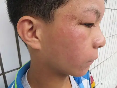 这个男孩面部红斑考虑什么