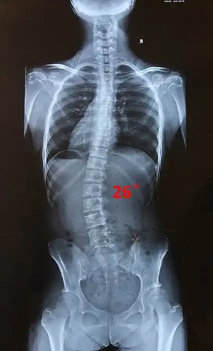 庄乾宇医生讲脊柱侧凸系列之三孩子得了脊柱侧凸该