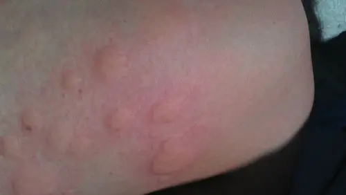 身上长了很多红色的包包!非常痒!