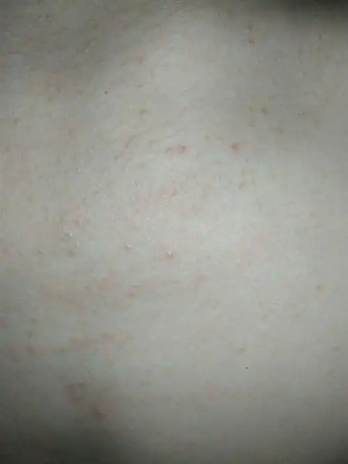 胸前长这样子的痘痘是怎么回事?是痱子吗?