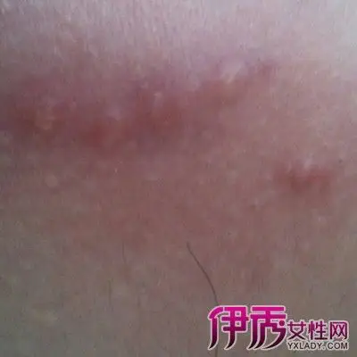 【图】什么是疱疹图片大全 6种常见疾病需注意