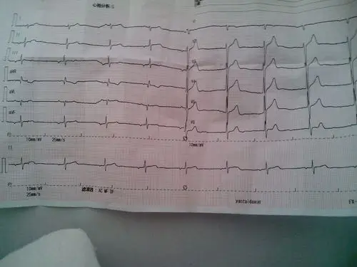 临界状态(异常的心电图),请帮我看一下.